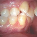  Ortodonzia Linguale Classica 