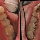 Ortodonzia Linguale Incognito