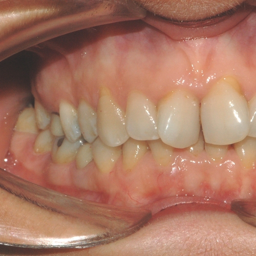 ortodonzia linguale estrazioni