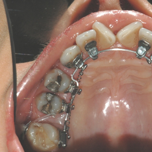 Ortodonzia linguale 