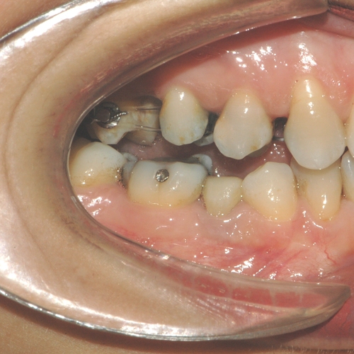 Ortodonzia linguale e estrazio