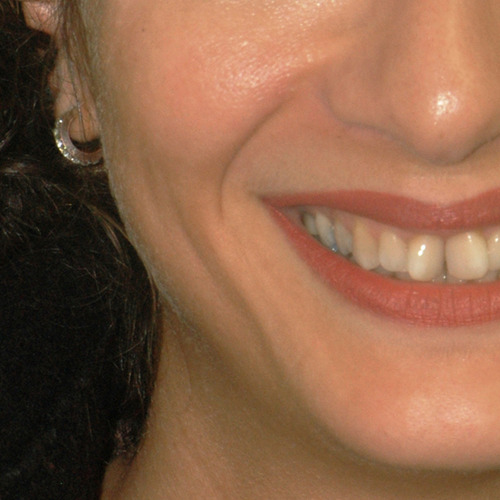 Ortodonzia linguale Sorriso  a