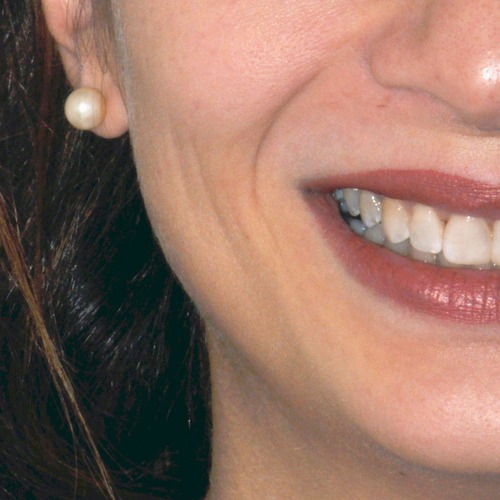 Ortodonzia linguale dopo (dent